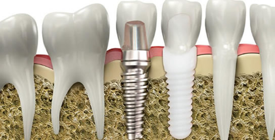 ceramic-implants