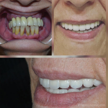 All-On-4 Implants