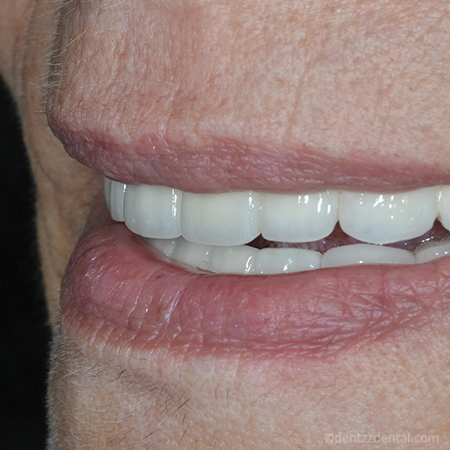 all-on-4-implants